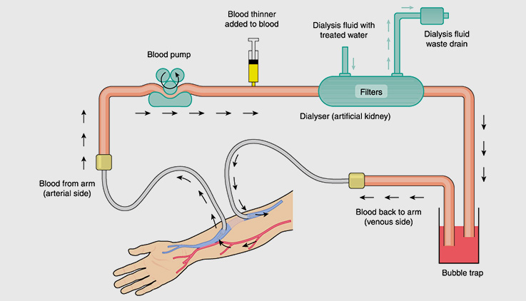 How Dialysis Works Diagram
